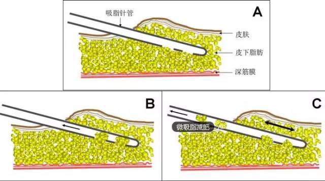 半永久化妆是微整形吗？两者有(yǒu)什么區(qū)别？